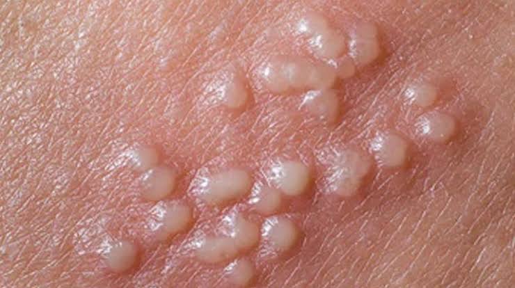 HPV چیست؟