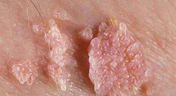 HPV چیست؟