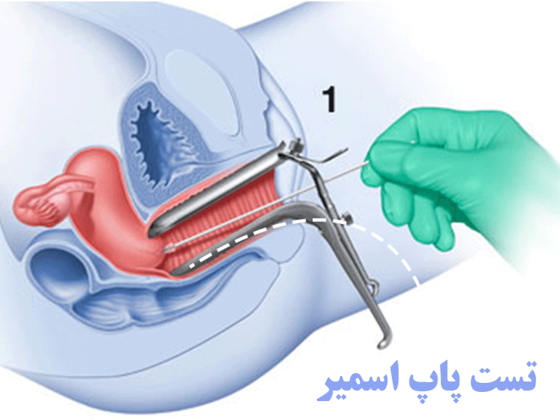 تست پاپ اسمیر چیست؟