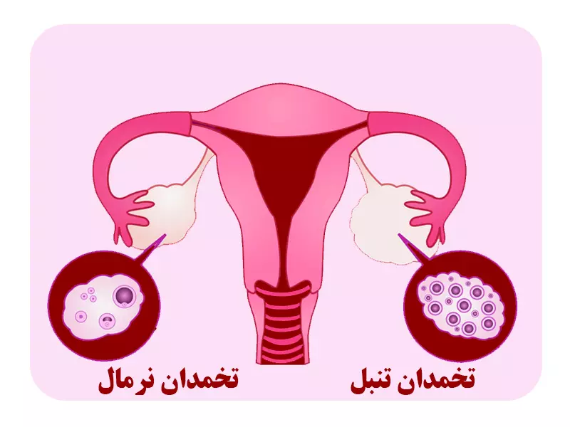 مشاوره تنبلی تخمدان